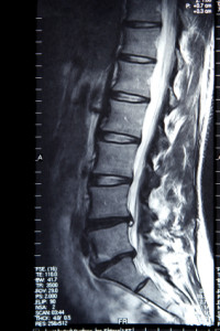 Physical therapy can help with your spinal stenosis