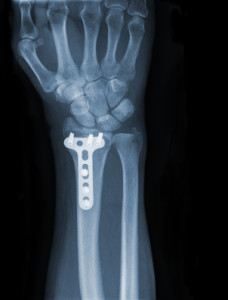 Physical therapists at Request Physical Therapy can help with your wrist fracture.