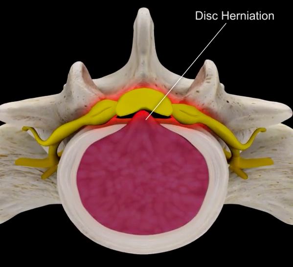Disc Herniation Cervical Spine