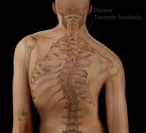 Treatment for Scoliosis